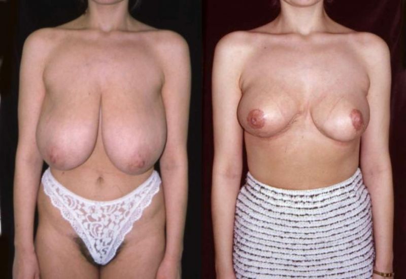 Aroused Inverted Nipples