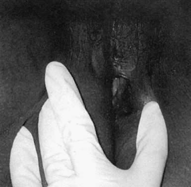 female genital infibulation