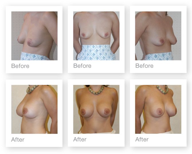 labiaplasty makeovers before and after