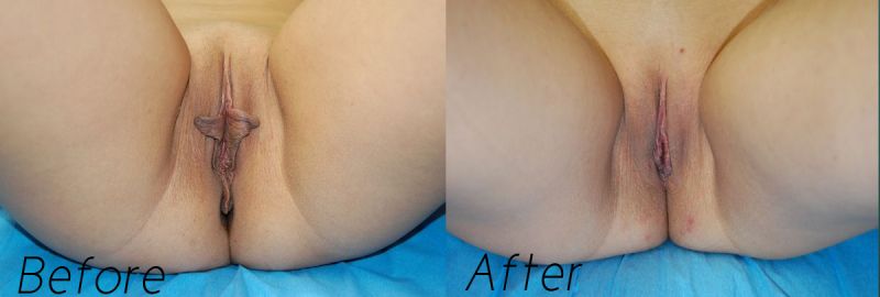 juvenile labiaplasty before and after