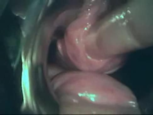 female urethra insertion