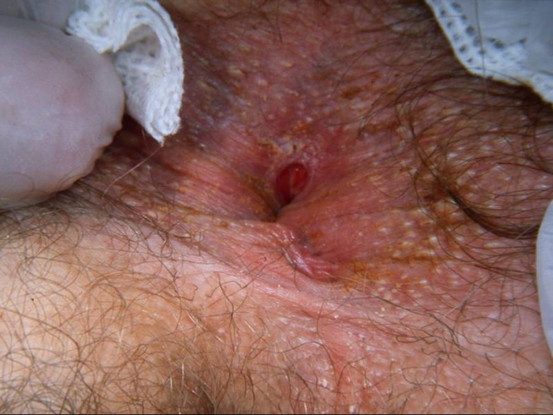 damaged anus from anal sex