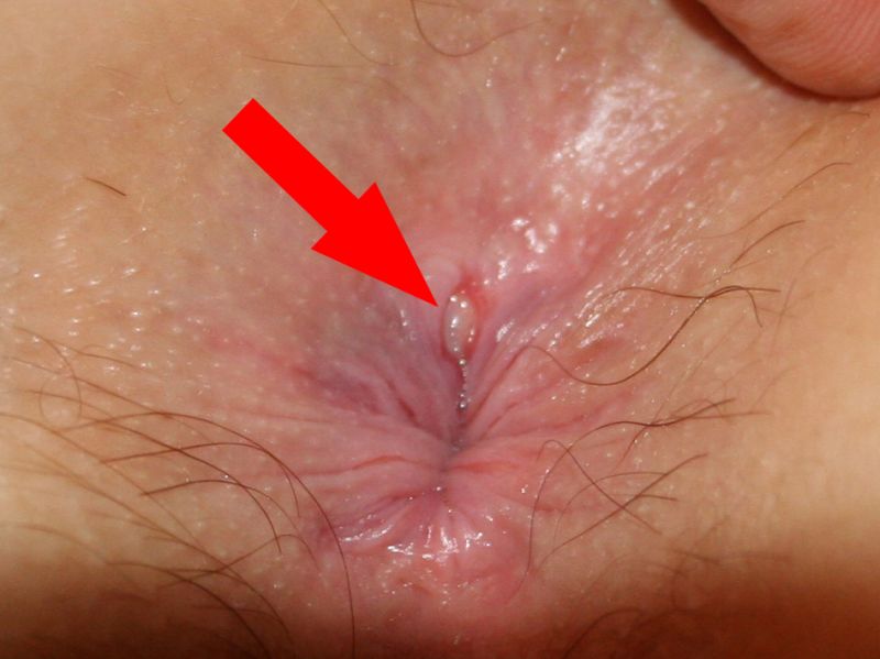 damage from anal sex