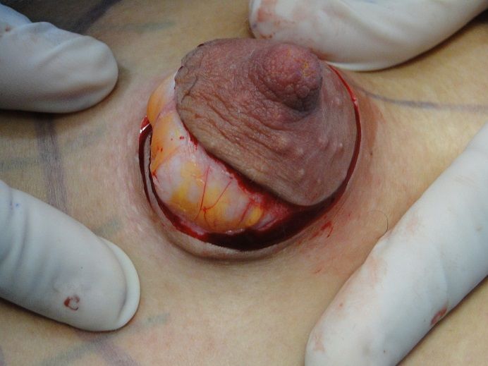 nipple implants