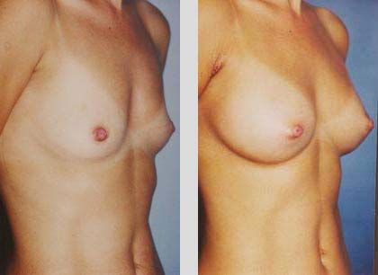 breastfeeding breasts before and after