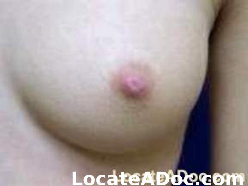 brooklyn decker inverted nipples