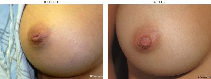 flat nipples