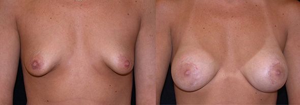 odd shaped breasts