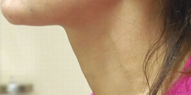 women neck pain