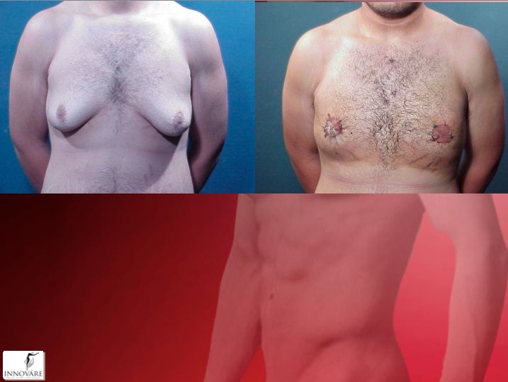 transgender bottom surgery