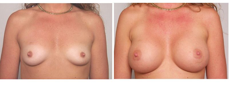 breast augmentation gallery
