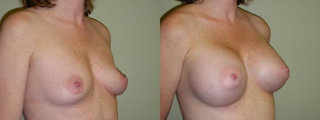 saline breast inflation