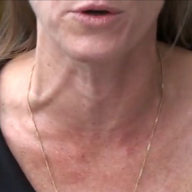 distended neck veins