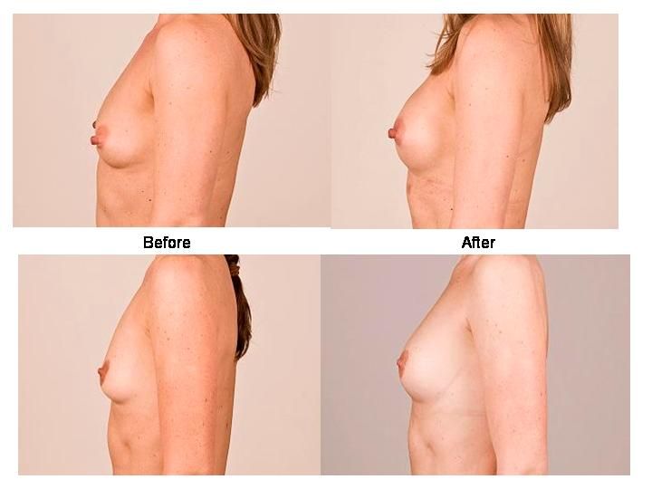 extreme saline injections in breast