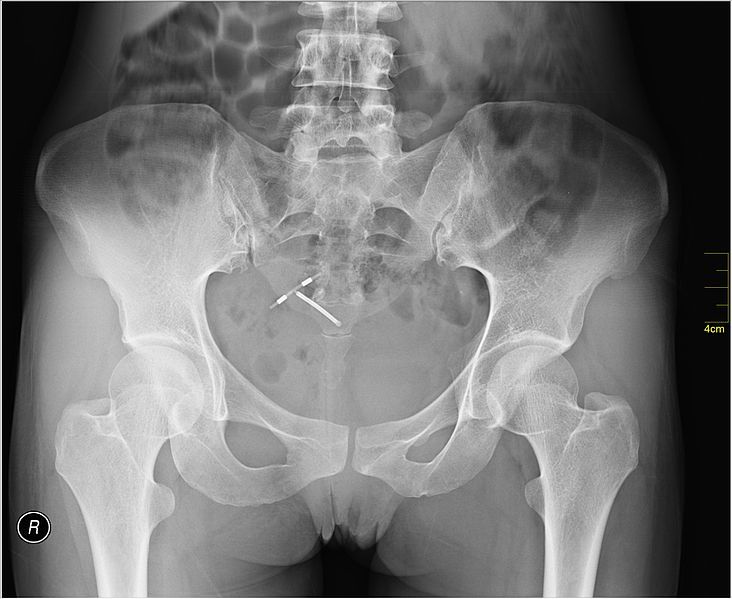 x ray penis inside vagina