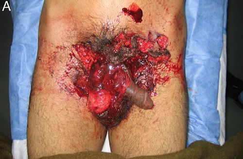 male genital injuries