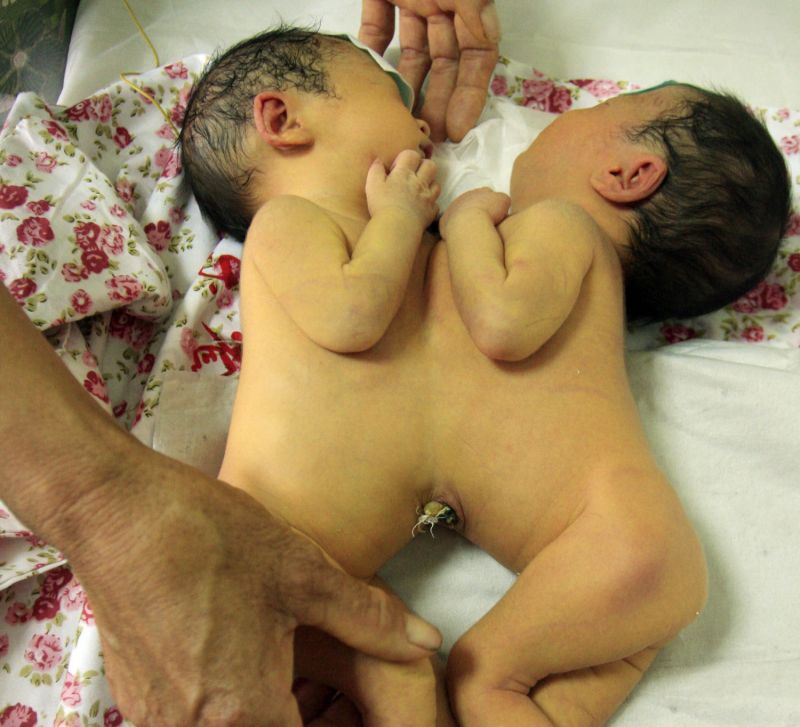 conjoined twins having sex