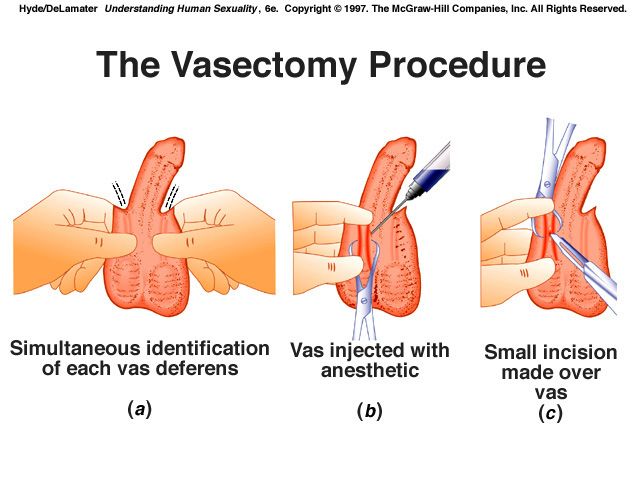 vasectomy before and after