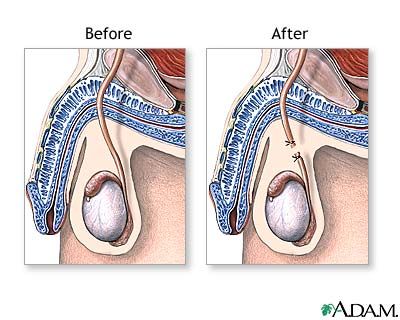types of vasectomy