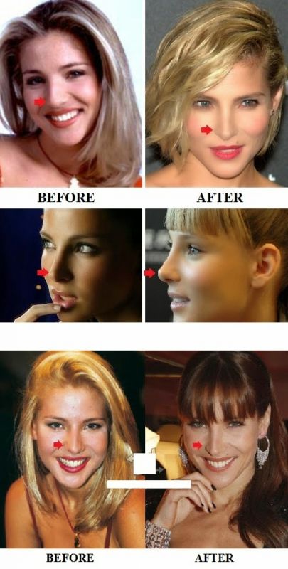 elsa patton plastic surgery before and after