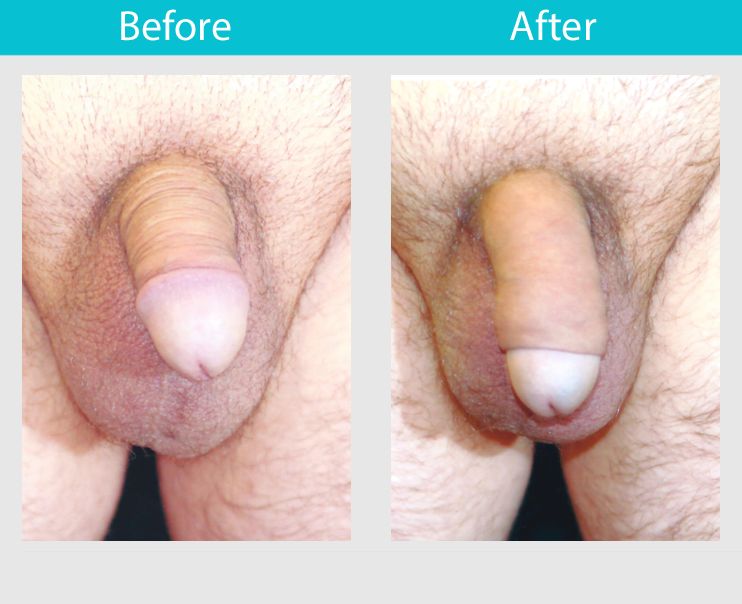 penile implants before & after