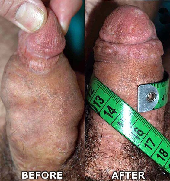 penis enlargement plastic surgery
