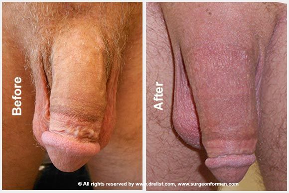 large penis enlargement surgery before and after