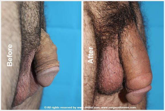 before and after penis enlargement surgery dallas tx