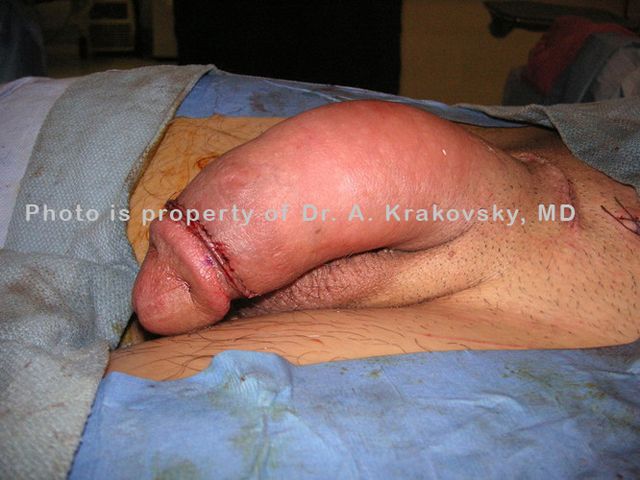 penis enlargement surgery results