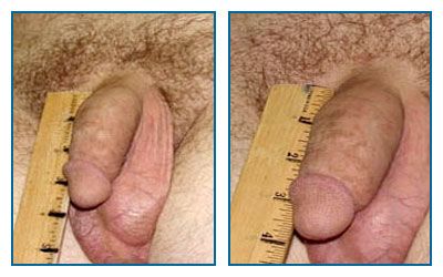 penis pumps before and after