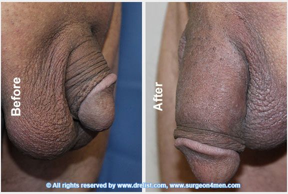 vagina tightening surgery before and after
