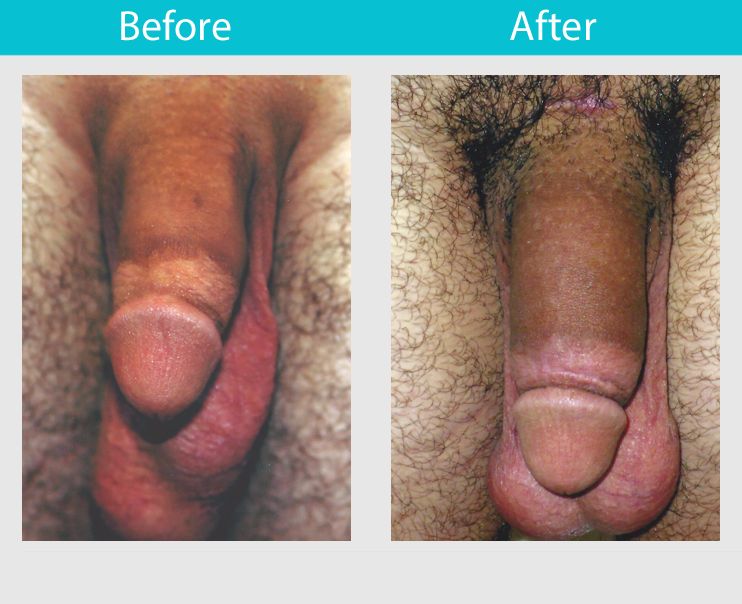 enlargement penile implants before and after
