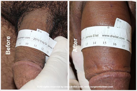 alloderm penis enlargement surgery before and after