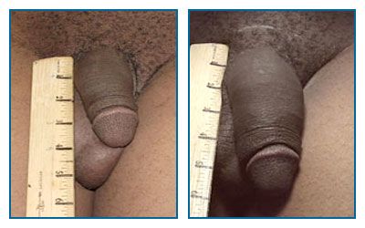 before and after penis enlargement pills
