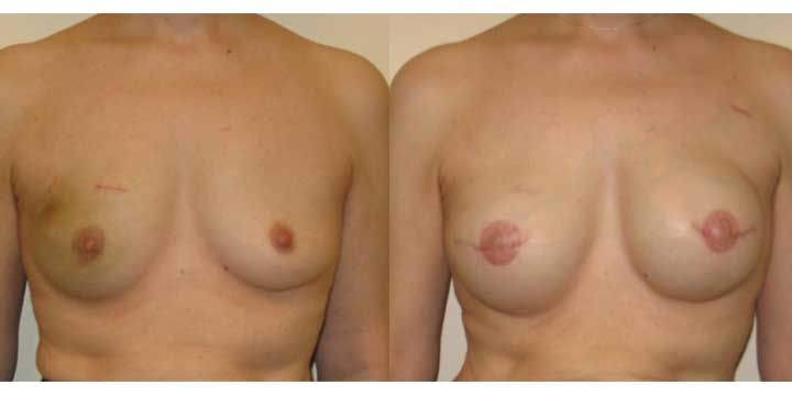 breast implants after mastectomy