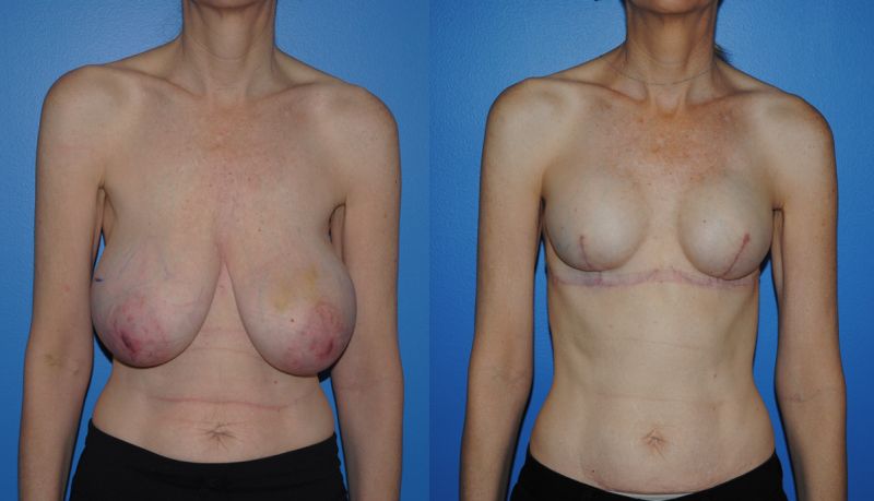 replacement of breast implant after mastectomy