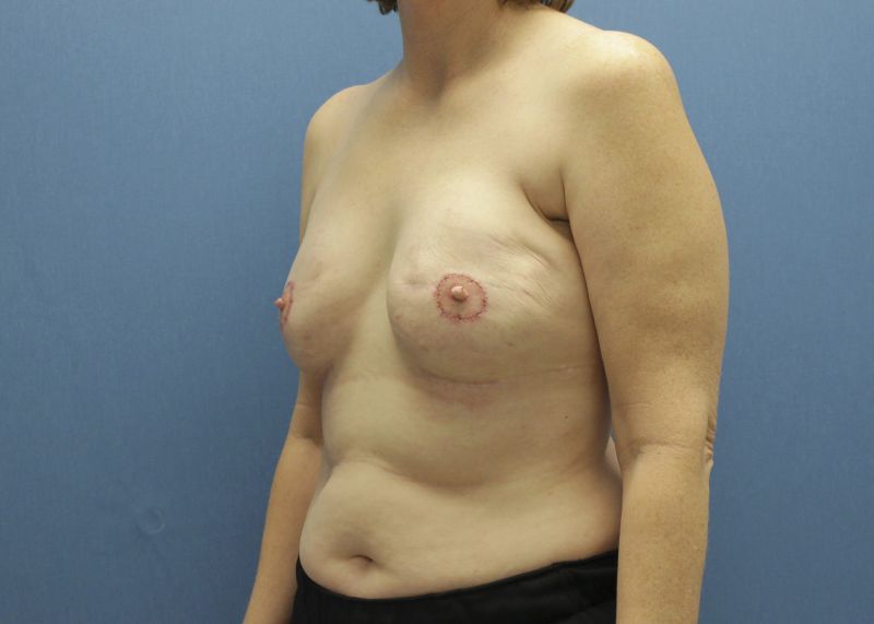 breast reconstruction after bilateral mastectomy