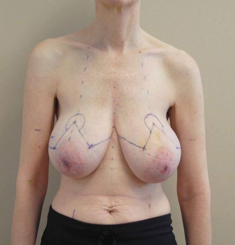 expander bilateral mastectomy recovery tips