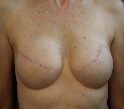 breast reconstruction after mastectomy implants