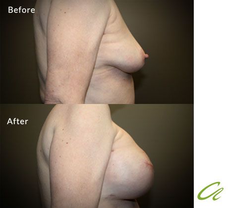 breast reconstruction without expanders