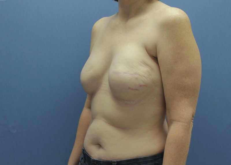 immediate breast reconstruction after mastectomy
