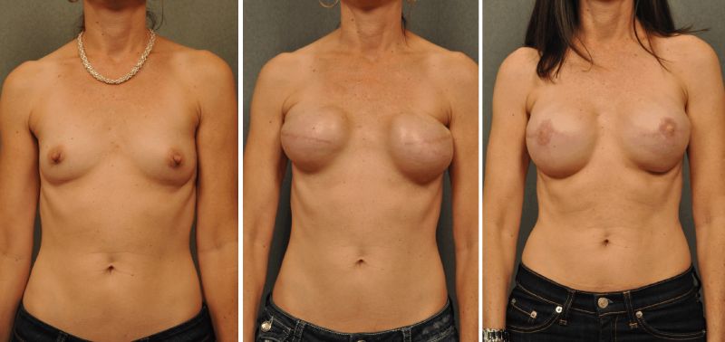 reconstruction after bilateral mastectomy