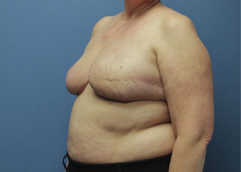 implant reconstruction after mastectomy