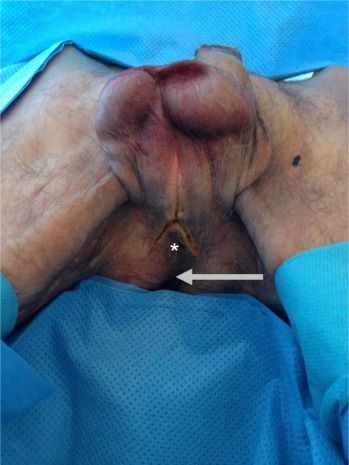 orchiectomy photos before and after