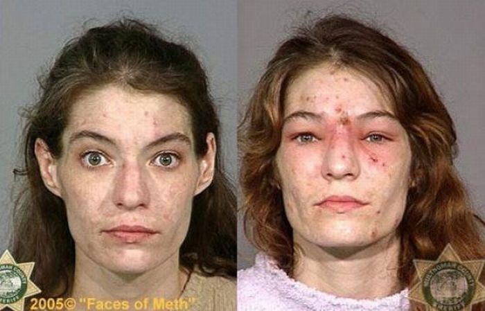 marijuana addicts before and after