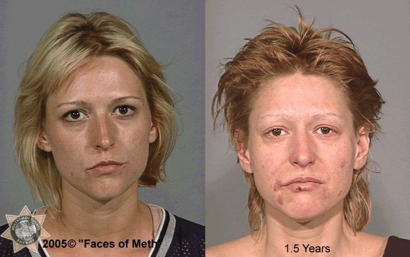 heroin addicts before and after