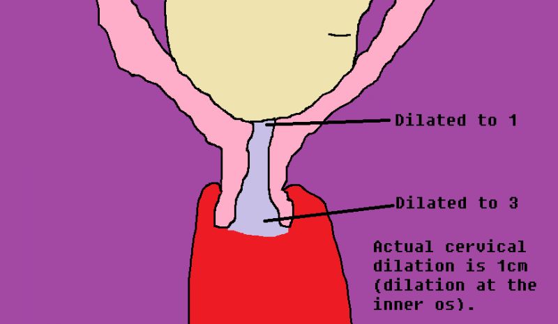 cervix dilation with finger