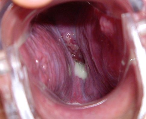 normal cervix
