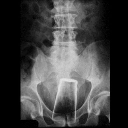 female x ray