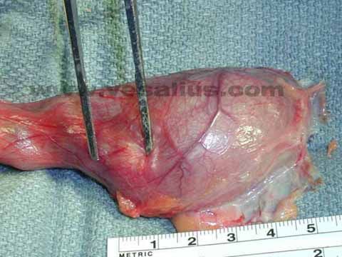 empty scrotum after a orchiectomy